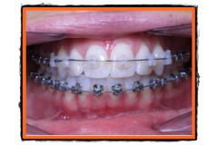 aparate ortodontice la copii